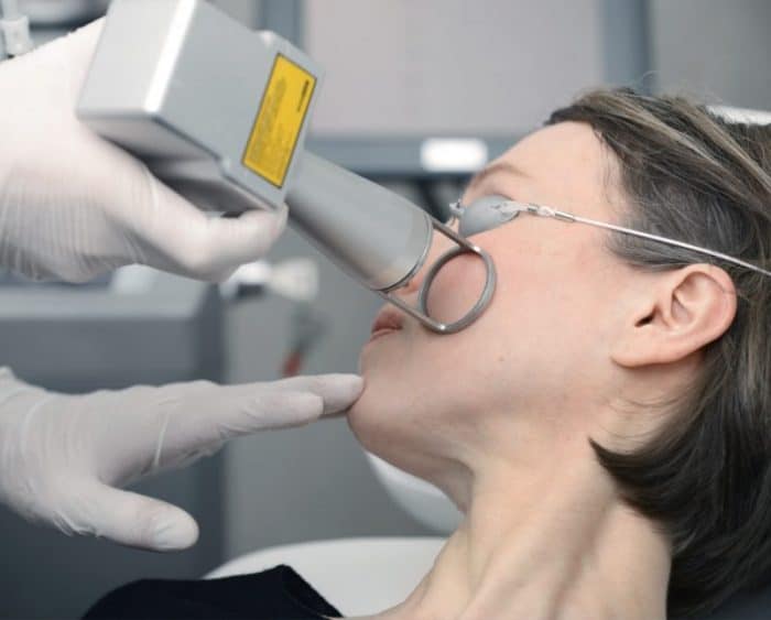 Laser abrasion visage